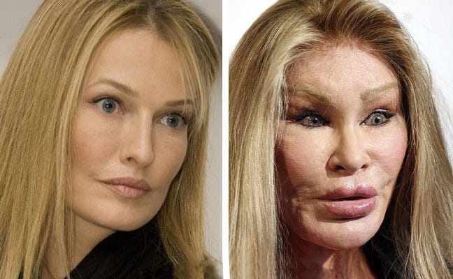 16 People Who Chased Plastic Surgery Down The Rabbit Hole