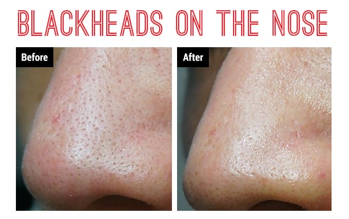 How To Get Rid Of Blackheads Overnight?