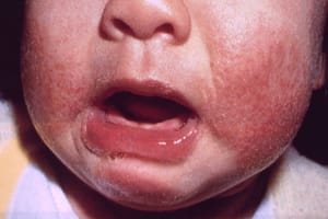 Mom Finds Miracle Treatment For Son's Excruciating Eczema On Facebook