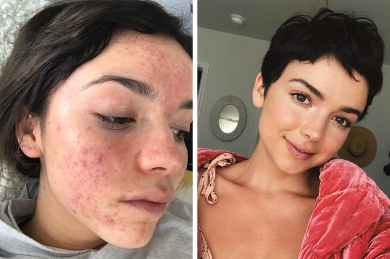 Acne Sufferers' Now Can protect Their Cells Against Ageing.