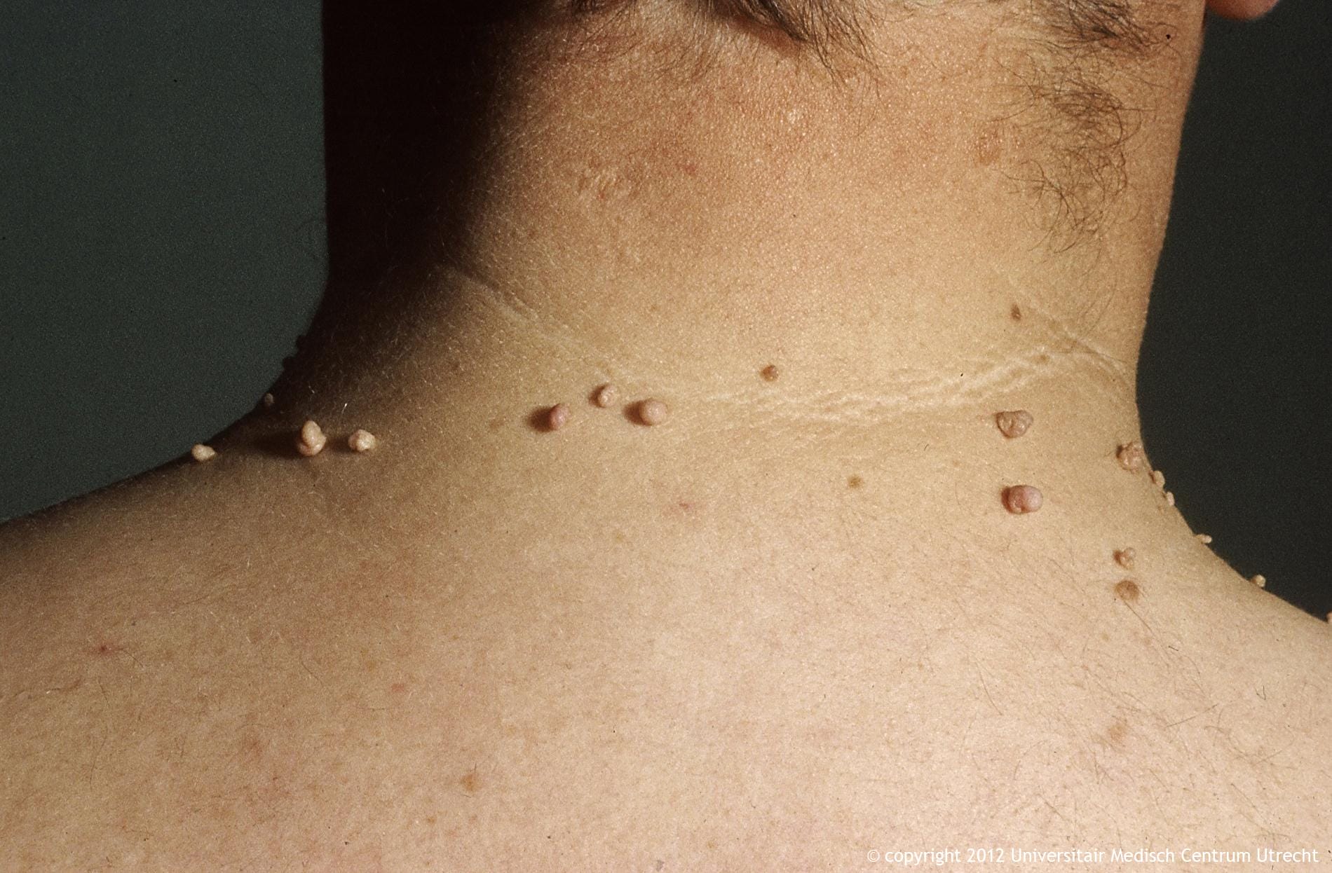 How To Quickly Remove Skin Tags With The Help Of Only One Ingredient