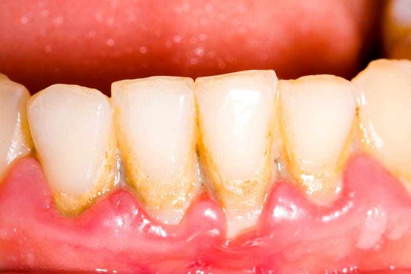 Plaque:  Very Simple Housewife’s Trick Which Will Let You Slip Out Of the Dentist’s Chair