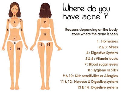 The Location Of The Body Acne Can Explain The Real Reason Why You Break Out