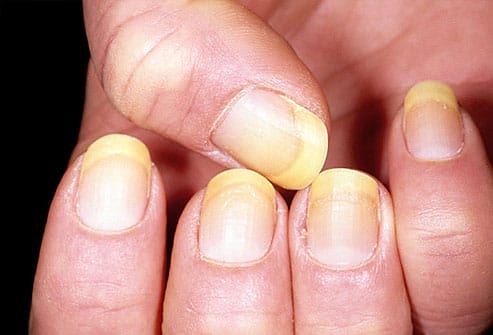 These 10 Types Of Nails Will Unveil Your Health Status.