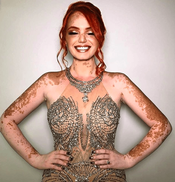 10 Magnificent Pictures That Prove Rare Genetic Conditions Are Beautiful