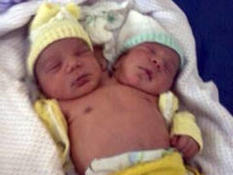 13 Interesting Things About Famous Conjoined Twins Abby And Brittany Hensel