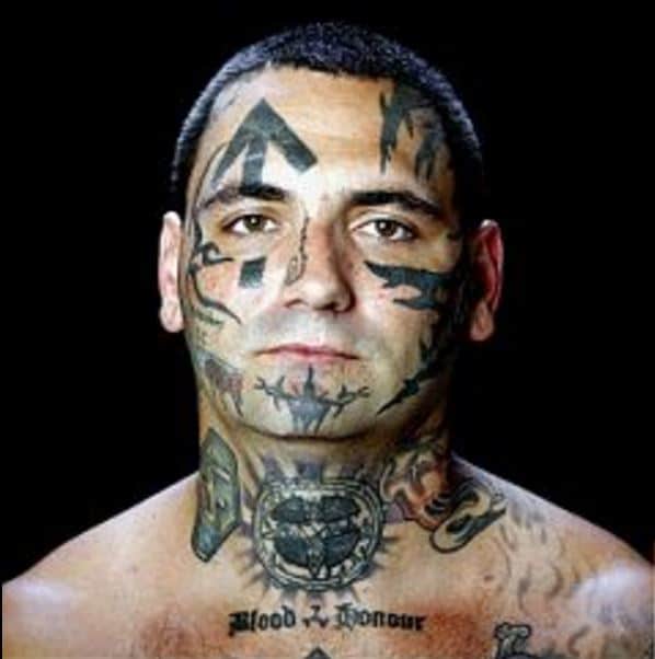 It took him 25 surgeries to be free from 'Hate'.