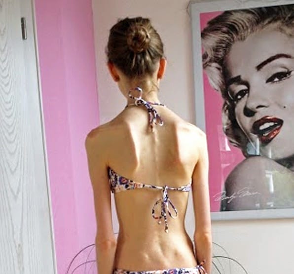 Love Helped This Girl Who Almost Died Of Anorexia Win The Battle For Life.