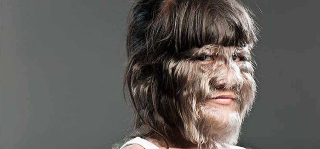 ‘World’s Hairiest Girl’ Shaves Her Face After Finding Love For The First Time