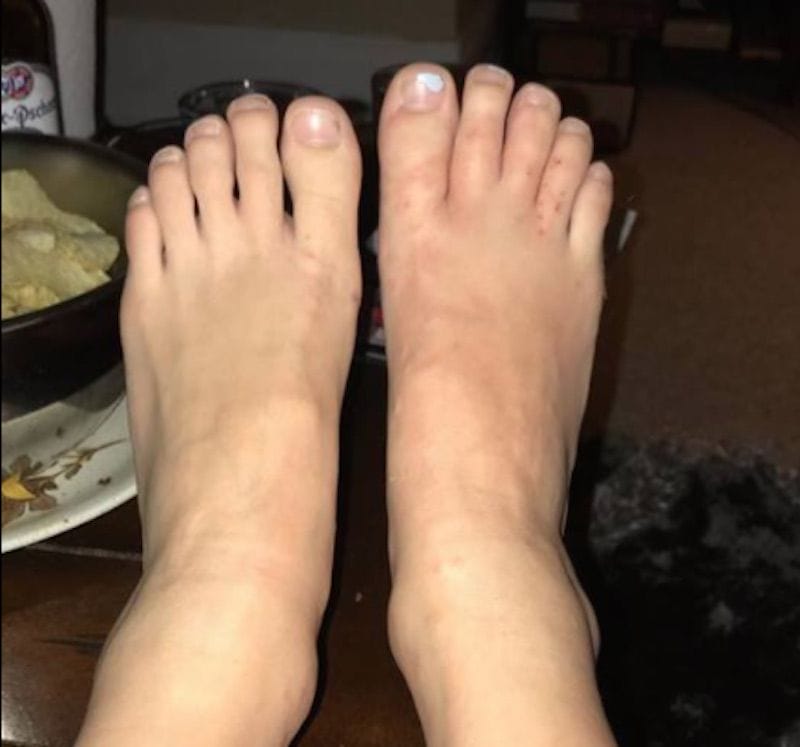 Horrifying: This Couples Facebook Post Shows The DANGERS Of Walking Barefoot On Beaches