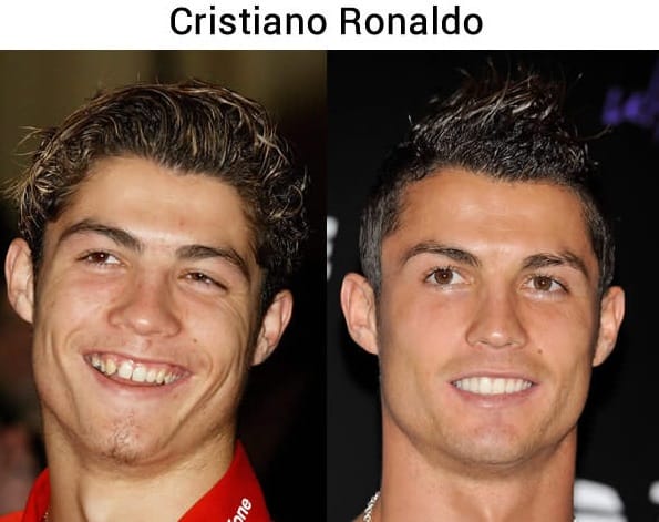 16 Before And After Photos Of Celebrities That Prove Good Teeth Can Change Your Entire Face