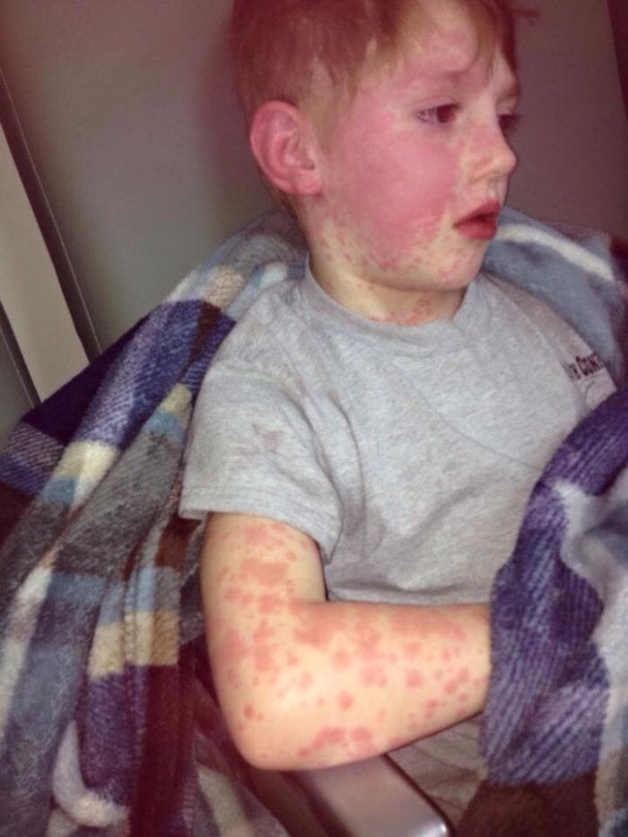Her Child Complained Of Poison Oak But Days Later, Doctors Make A HORRIFIC Discovery