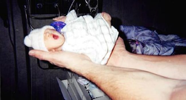 Nurses Nicknamed Her 'Thumbelina'. 12 Years Later? This Is Remarkable!