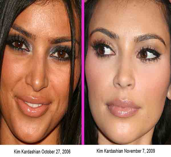 Stars Before And After Cosmetic Surgery