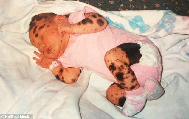 Their Newborn Was Covered In Hundreds Of Birthmarks, But Look At Her 19 Years Later!
