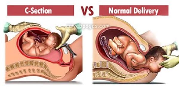 Know the Differences Between Vaginal Birth or C Section which is better
