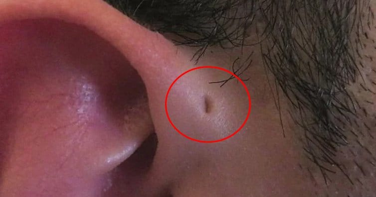 1 in 100 People In The UK Have This Hole Above Their Ear Since Birth. Here's Why