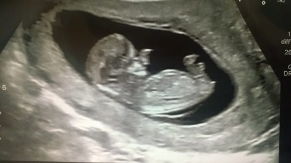 Baby Has A Huge Nose In The Ultrasound. When He Is Finally Born Mom Can't Speak