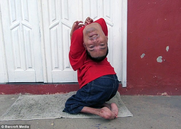 Doctors Suggested His Mom To Let Him Die. But Thank God He Is Still Alive. See What He Did...