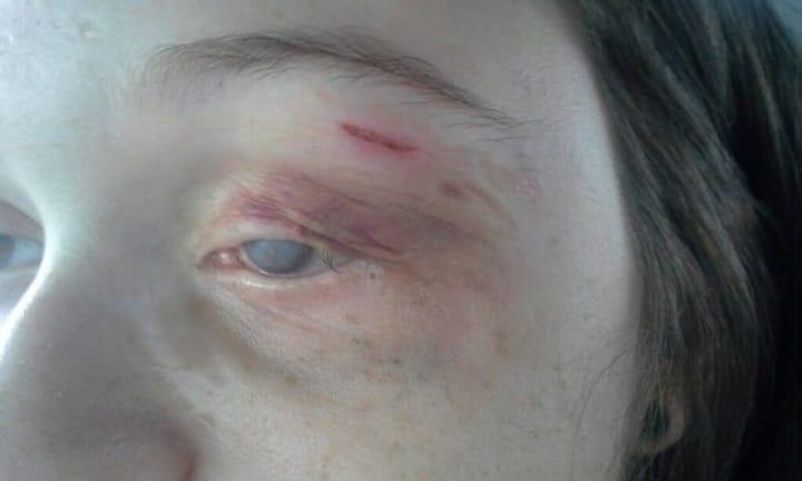 Half-Blind Teenager with Cancer Abused By The TSA For Being Confused During A Search