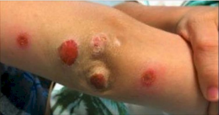 Her Son Came Home From A Party With These Strange Marks. When Doctors Revealed The Cause? Shocking.
