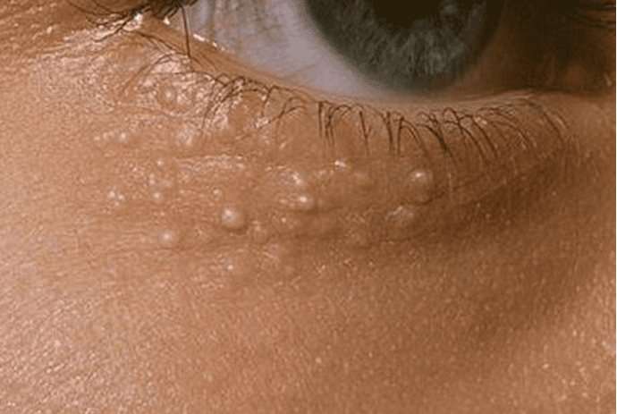 If You Have These Annoying White Dots On Your Face, You Should BEWARE!