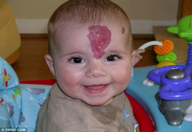 Kid Suffered Horns Implant As Birthmark Treatment. This Is How He Looks Now