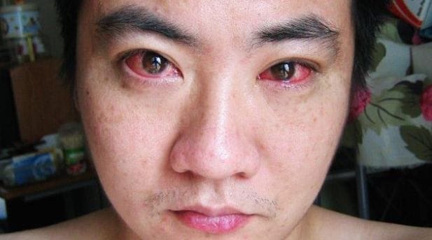 Man Almost Diagnosed With Eye Cancer Because Of Doing This At Night