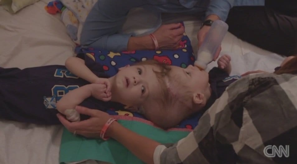 Mom And Dad Says Goodbye To Their Conjoined Twins Moments Before Their Surgery. This Is Heart Warming...