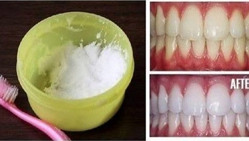 Natural teeth whitening - DIY tip to clean your teeth at the comfort of your hom
