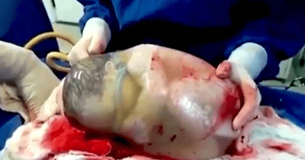 Nurse Films The Rare Moment A Baby Is Born Inside A Fully Intact Amniotic Sac