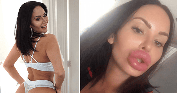 Plastic Surgery Addict Butt Implants Are So Big She Can’t Sit Down
