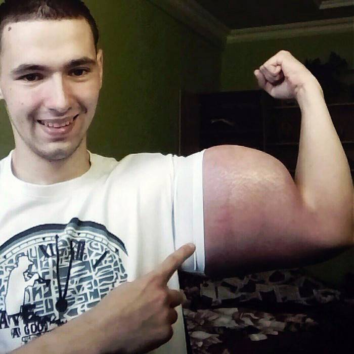 Real Life 'Popeye' May Need To Have His Arms Amputated