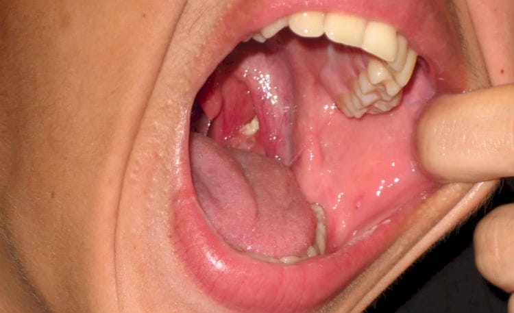 She Had Horrible Breath And Didn't Know Why. Then She Found THESE In Her Throat!