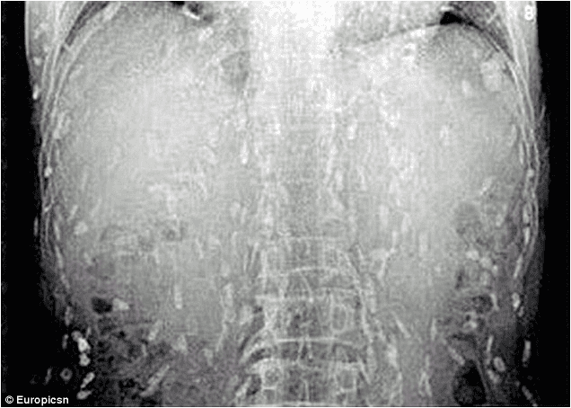 Sushi Lover Ends Up With His Entire Body Riddled With Worms
