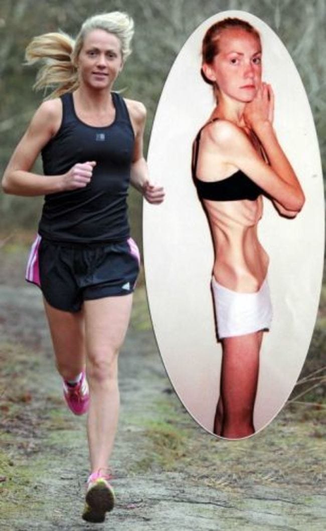 These 10 Anorexic Girls Look Stunning After Beating Their Condition