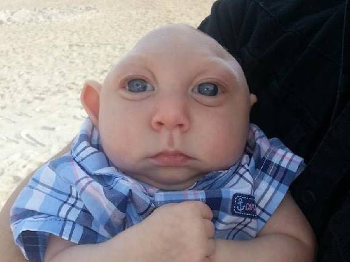 They Asked The Parents To Terminate The Baby Because Of It's Unusual Head Shape Saying It Would Die Soon After Birth...But The Parents Took A Chance And Now This Happened!