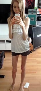This Girl Inspired the World To Live After Almost Dying Because Of Anorexia